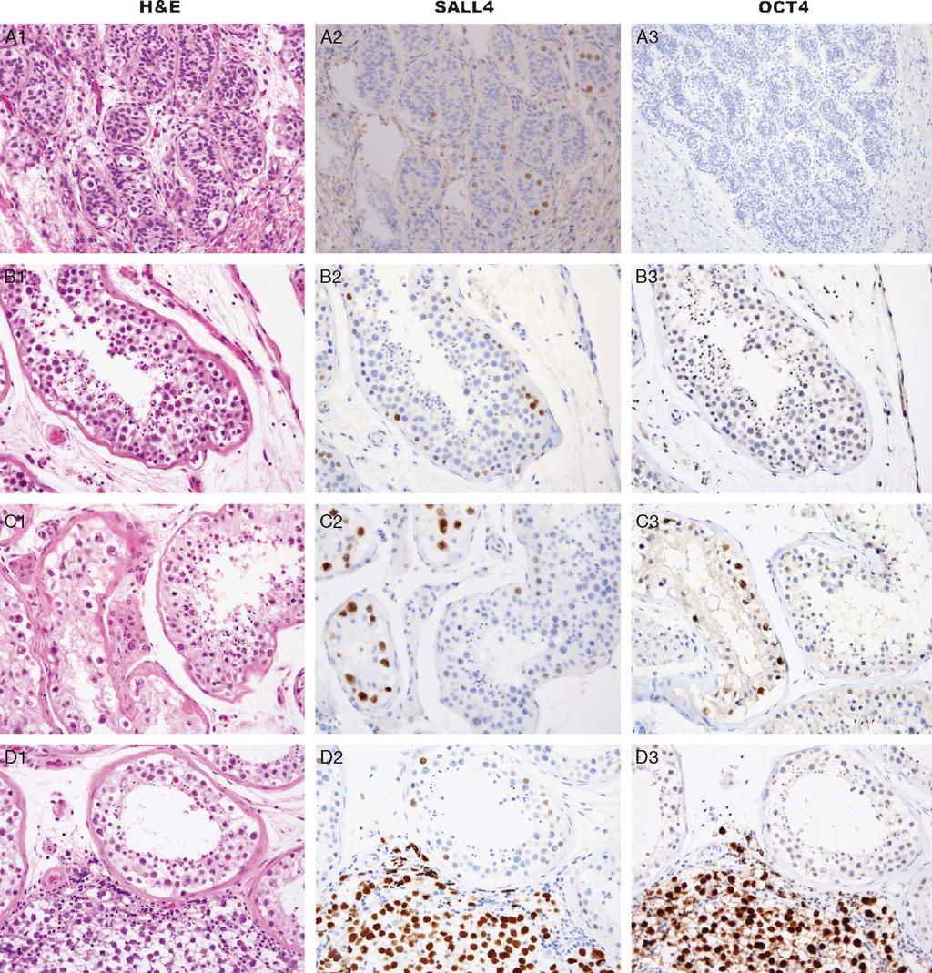 Cao et al Am J Surg Pathol Volume 33, Number 7, July 2009 FIGURE 8. Immunohistochemical staining of SALL4 in non-neoplastic testicular tissue.