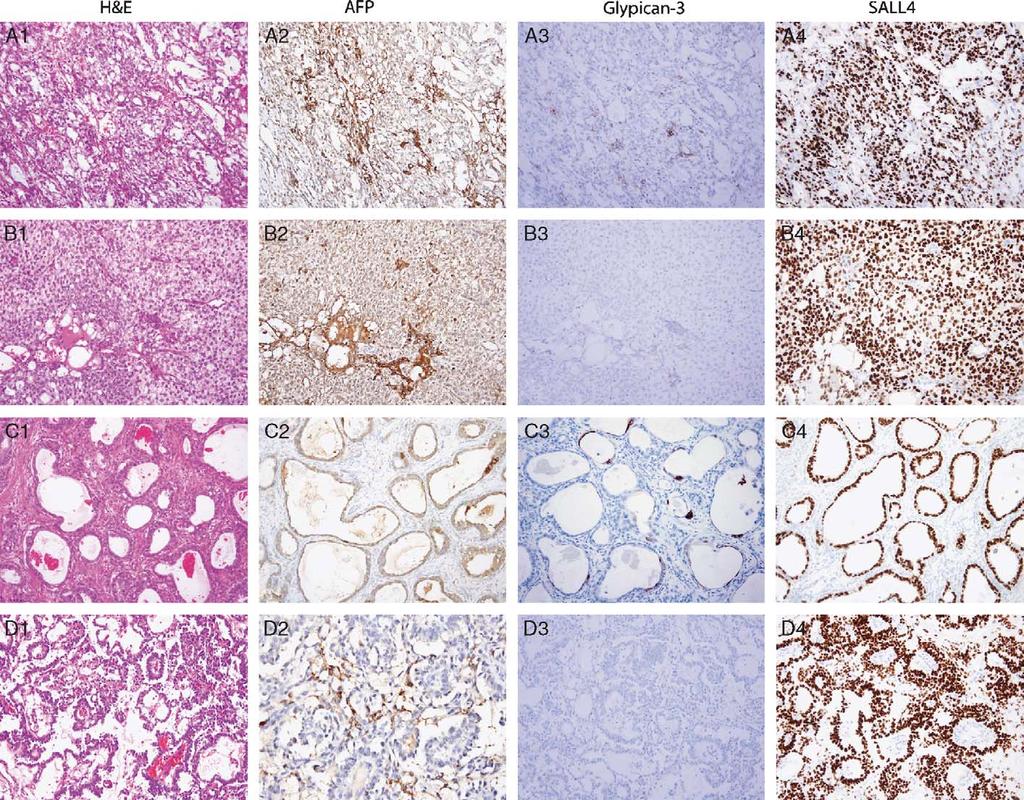 Am J Surg Pathol Volume 33, Number 7, July 2009 Novel Diagnostic Markers in Testicular Germ Cell Tumors FIGURE 5.