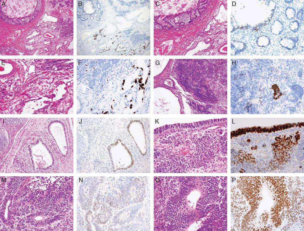 Cao et al Am J Surg Pathol Volume 33, Number 7, July 2009 FIGURE 6. Immunohistochemical staining of SALL4 in pediatric (A H) and postpubertal (I P) testicular teratomas.