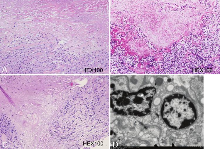 A. Liu et al. Fig.. Histological changes for different tumor types several months after GKS, showing coagulation necrosis with sharp demarcation in the tumor parenchyma.