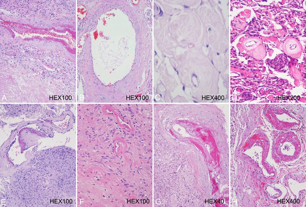 Analyses of benign tumors after failed GKS Fig. 3. Proliferative vasculopathy in the stroma after GKS, showing vascular changes of meningiomas at different intervals (A D).