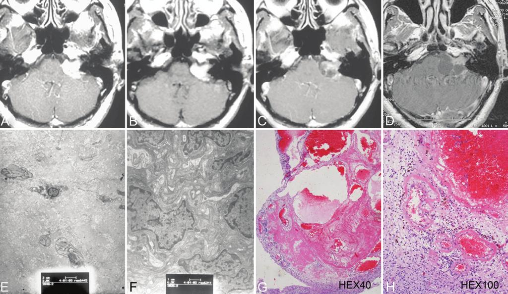 A. Liu et al. Fig. 6. Vestibular schwannoma. The patient underwent microsurgery 7.5 years after GKS because of cyst formation and compression of the brainstem.