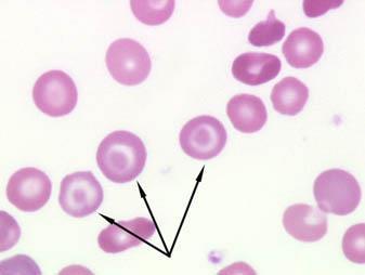 Target Cell - Peripheral Smear Sign of decreased hemoglobin content relative