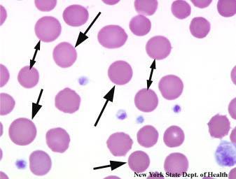 Blood Destruction/Hemolysis Spherocytosis Autosomal dominant RBCs are normally concave In this disorder they are spherical, which makes them subject to destruction (especially in