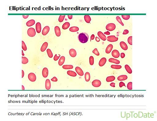 Blood Destruction/Hemolysis Elliptocytosis Hereditary hemolysis Elliptocytosis- uncommon in USA o Much more common in