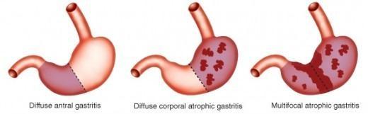Pathology: Three states of chronic gastritis are usually considered in dealing with its pathology are 4.3.1.Simple catarrhal: In this type an increased amount of mucin is secreted.