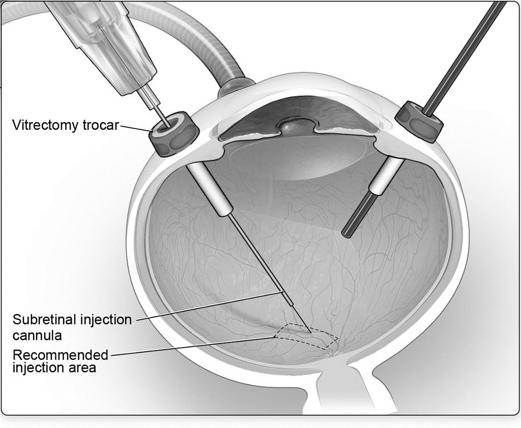 Figure 4. Volume of LUXTURNA for Injection 6. After completing a vitrectomy, identify the intended site of administration. The subretinal injection cannula can be introduced via pars plana.