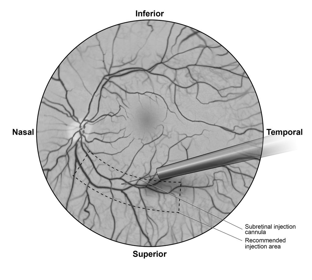 The recommended site of injection is located along the superior vascular arcade, at least 2 mm distal to the center of the fovea (Figure 5b), avoiding direct contact with the retinal vasculature or