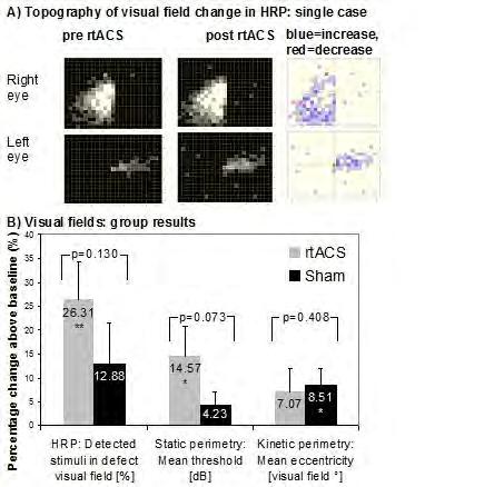 Figure 1: Visual field change A) in a single patient of the rtacs group, B) group results of different visual field