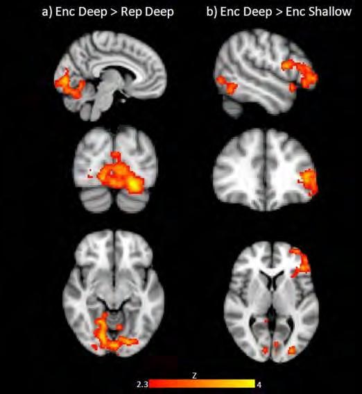 Time*Stimulation interaction. Red-yellow areas represents an increased BOLD response after real itbs compared to sham (1) Solé-Padullés et al (2006). Cereb Cortex, 16 (10): 1487-93.