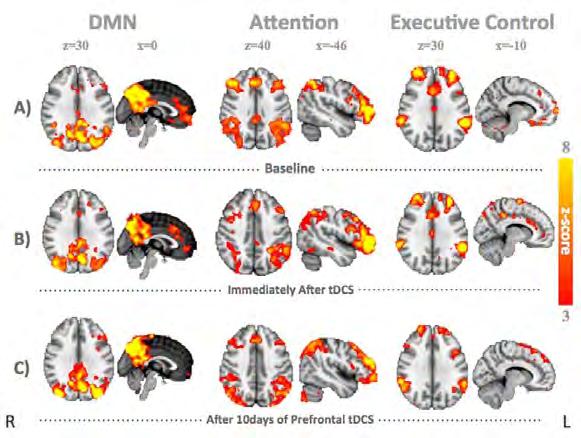 Poster Session II Multimodal Approaches P 199 Prefrontal transcranial direct current stimulation (tdcs) changes negative symptoms and functional connectivity MRI (fcmri) in a single case of
