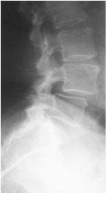 Fig. 19: L4-5 spondylolysthesis on axial X-ray image Cervicobrachial pain, discal herniation at the cervical level MRI is the optimal diagnostic method C.V-VI, VI-VII.