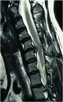 cervical spondylosis may lead to spinal cord compression In cervical spondylotic myelopathy, spinal cord involvement is the primary symptom, associated with various combinations of secondary symptoms