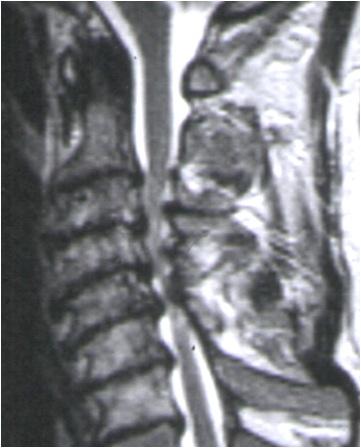 Common causes of slowly developing spinal cord compression include cervical medial discal herniation, ostheoarthrosis of the vertebrae, thickened posterior longitudinal ligament, and bulging alar