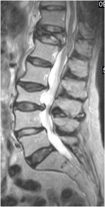 was found in low back pain.