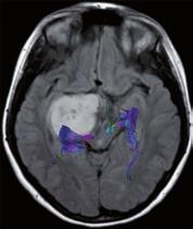 (B) Right thalamic tumor smoothly displaces the right corticospinal tract to posterior, which is consistent with a good respectability criterion.