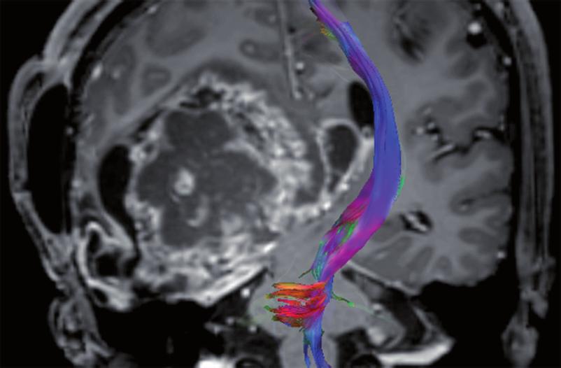 Diffusion-tensor imaging in brain tumors REVIEW Limitations There are a number of limitations of DTI arising from its technique or applications.