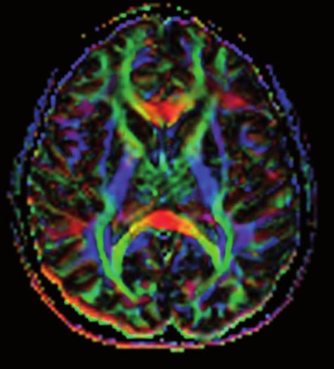 High signal intensity characteristics of brain abscesses, epidermoid tumors and lymphomas on DWI may be helpful to differentiate them from cystic/necrotic tumors and metastases, arachnoid cysts and