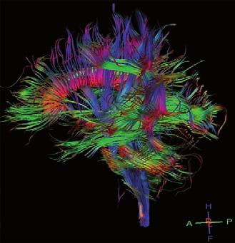 Diffusion-tensor imaging in brain tumors REVIEW Figure. 3D tractography images in normal volunteer.