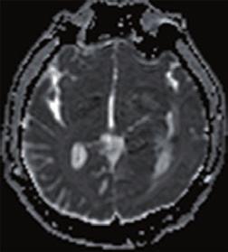 A lower incidence of destructive changes and more preservation of white matter tracts in low-grade tumors causes a smaller reduction in FA values than high-grade tumors.