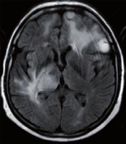 Diffusion-tensor imaging in brain tumors REVIEW apparent water diffusivity when compared with the contralateral white matter and may complicate diagnosis by resembling high-grade gliomas [67].
