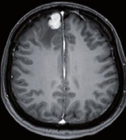 extra-axial meningioma at the right frontal region causing prominent edema (arrowheads) in adjacent brain parenchyma.