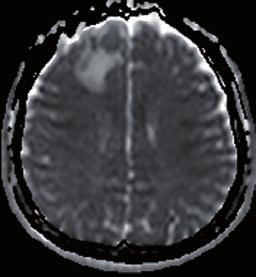 demonstrated by using l - chart ana lysis that the apparent water diffusivity of peritumoral edema was significantly higher in high-grade gliomas than in both metastases and