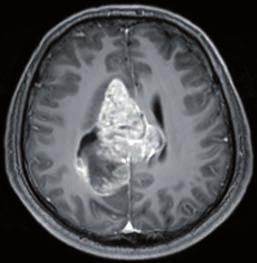 central neurocytoma located at the right lateral ventricle and corpus callosum with very low apparent diffusion coefficient values with faint peritumoral edema resembling high-grade