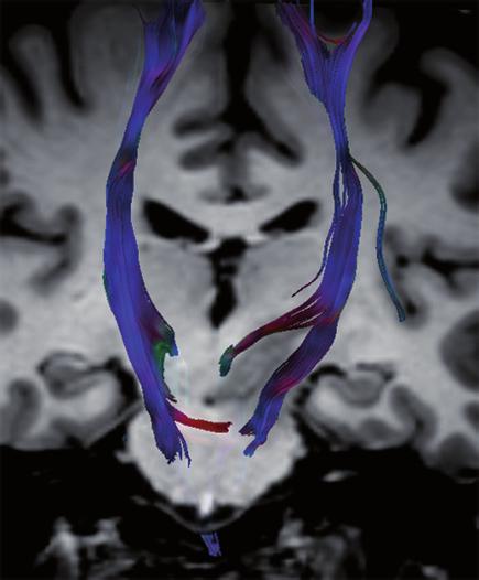 The fmri-guided DTI applications allow a more comprehensive and functionally related white matter mapping than DTI by increasing the tracking ability of DTI in infiltrated white
