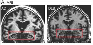 COGNITIVE PATTERNS IN DLB Vascular Dementia (VaD) Diagnostic Criteria MEMORY AND LANGUAGE Relative preservation of medial temporal lobe in DLB Memory and object naming tend to be less affected in