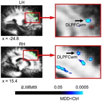 MDE MDD subjects exhibited reduced FA in white matter regions underlying dorsolateral prefrontal cortex (DLPFCwm), bilaterally.