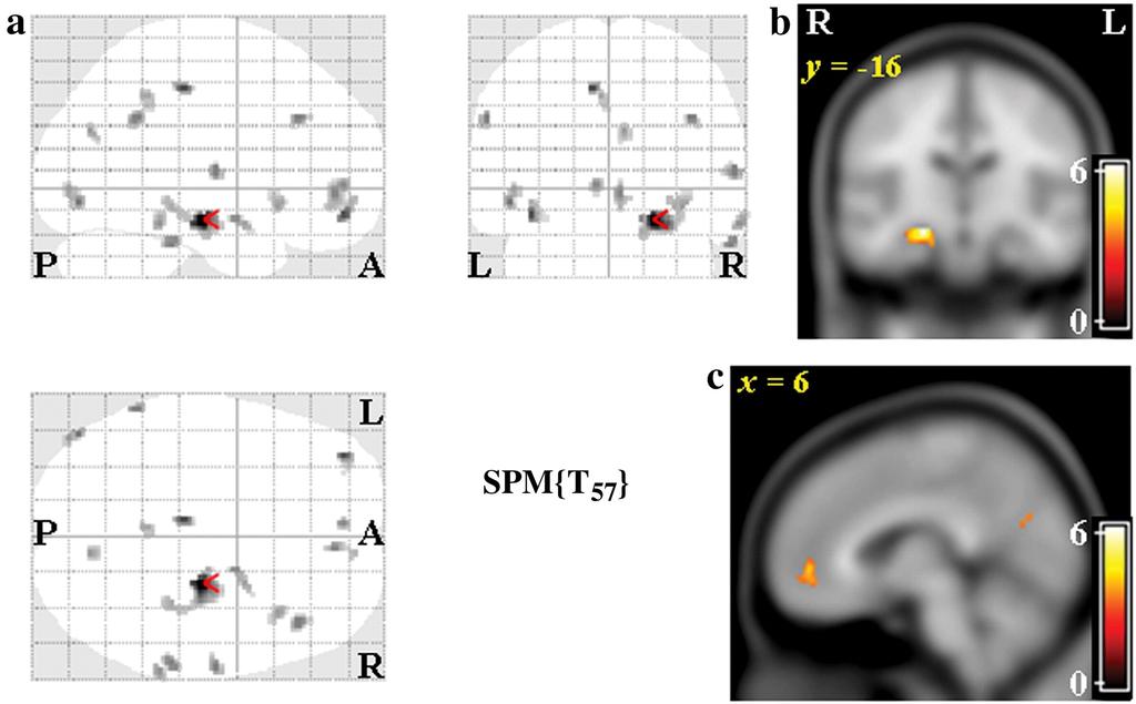 Areas with significant gray matter volume reduction in depressive patients compared with normal subjects.