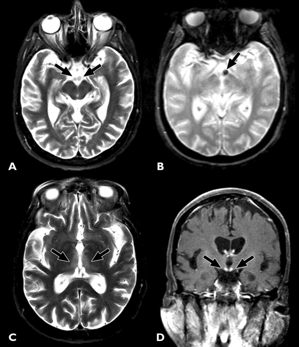 Wernicke's --61-year-old alcoholic man with Wernicke encephalopathy during acute phase of disease