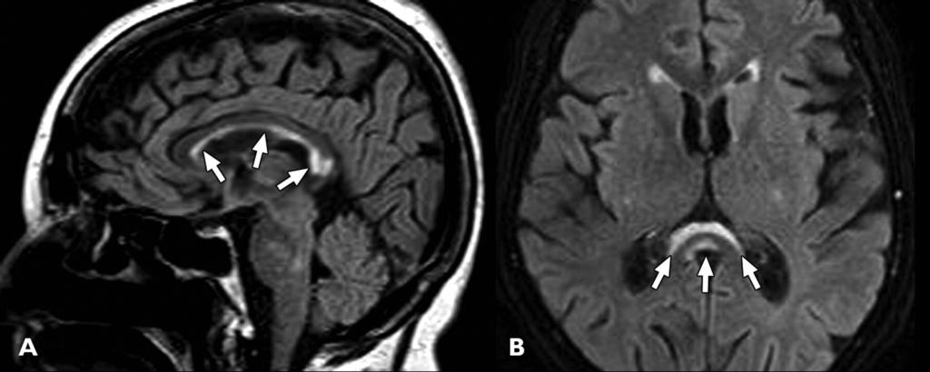 --53-year-old alcoholic woman with Marchiafava-Bignami disease during