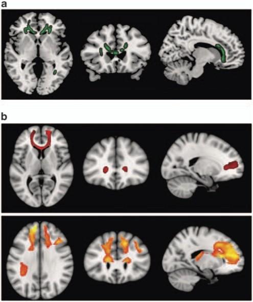 Diffusion tensor imaging (DTI) findings. Top panel (a) shows areas of significant fractional anisotropy (FA) reduction in the schizophrenic patients identified using TBSS thresholded at P=0.01.