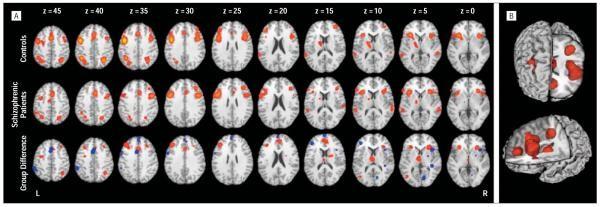 Global analysis of executive function studies in schizophrenia. A, Brain regions with significant activation across executive function task types.