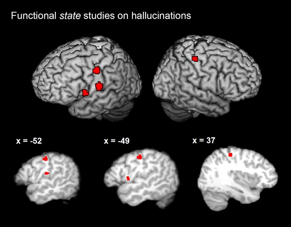 State Activation Likelihood Estimation Meta-Analysis Maps for Correlates of Presence vs Absence of Auditory Verbal Hallucination in Schizophrenic Patients Demonstrating Significant Concordance Across
