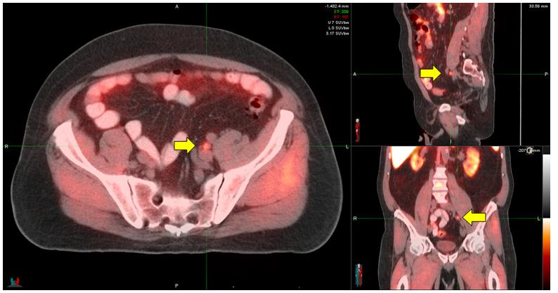 The prostate recurrence was confirmed by biopsy with subsequent Brachytherapy performed. The PSA decreased to 0.6 ng/ml after treatment. Case Example 3. Gentleman with Gleason 6 prostate cancer.