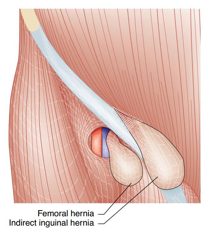 - Incisional hernia - Doctor s Slide Introduction to Direct and Indirect Inguinal Hernia Definition: bulge or protrusion at or near