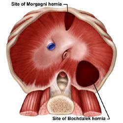 Umbilical hernia: Hernia through the umbilical ring, in adults associated with ascites, pregnancy, and obesity Intraparietal hernia: Hernia in which abdominal contents migrate between the layers of