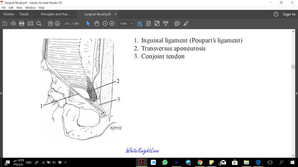 real lipoma; remove surgically, if feasible What is a small outpouching of testicular tissue of the testicle? Testicular appendage (a.k.a. the appendix testes); remove with electrocautery What action should be taken if a suture is placed through the femoral artery or vein during an inguinal herniorrhaphy?