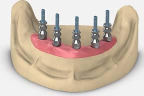 Hand tighten the screws. Use a soft tissue model material around the abutment replicas.
