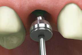 The procedure creates a model that represents the exact position of the implant and the soft tissue profile.