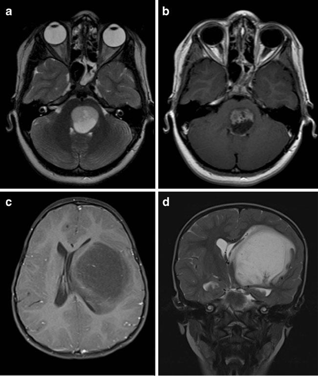 130 J Radiat Oncol (2013) 2:129 133 intracranial pressure. Very young children with large hypothalamic LGGs may present with failure to thrive, otherwise known as the diencephalic syndrome.