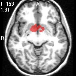 Cluster of differences in correlations of left medial thalamic DA
