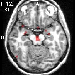 Cluster of differences in correlations of left medial thalamic DA