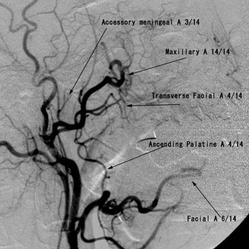 N Kashiwagi, K Nakanishi, T Kozuka et al Figure 1. Lateral view of the external carotid angiogram. A, artery. extension to the retromaxillary fat pad and pterygopalatine fossa.