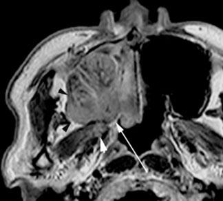 Pictorial review: Vascular supply of maxillary cancer (a) (b) (c) (d) (e) (f) Figure 3. A 42-year-old man with T4 right maxillary cancer.