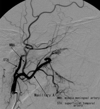 In addition, the tumour shows further extension to the medial pterygoid muscle (long white arrow). (b) Digital subtraction angiography (DSA) of the main trunk of the external carotid artery.
