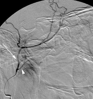 MMA, middle meningeal artery; STA, superficial temporal artery.